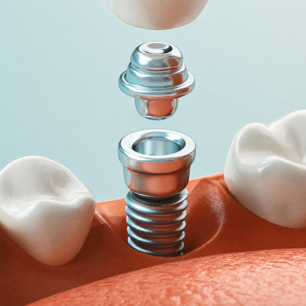 Dental restoration
